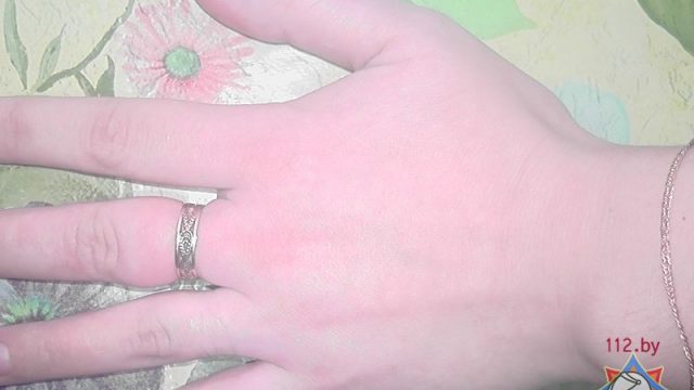 В Гомеле женщина не смогла снять кольцо с отекшей руки: понадобилась помощь спасателей